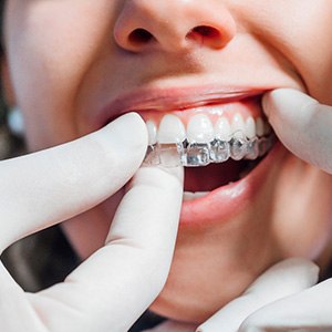 Dentist with white gloves putting on clear aligner