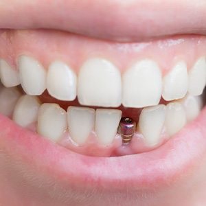 Smile with dental implant