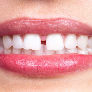Closeup of a smile with diastema