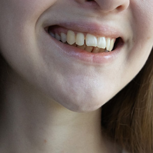 Nose-to-neck view of woman with overbite smiling