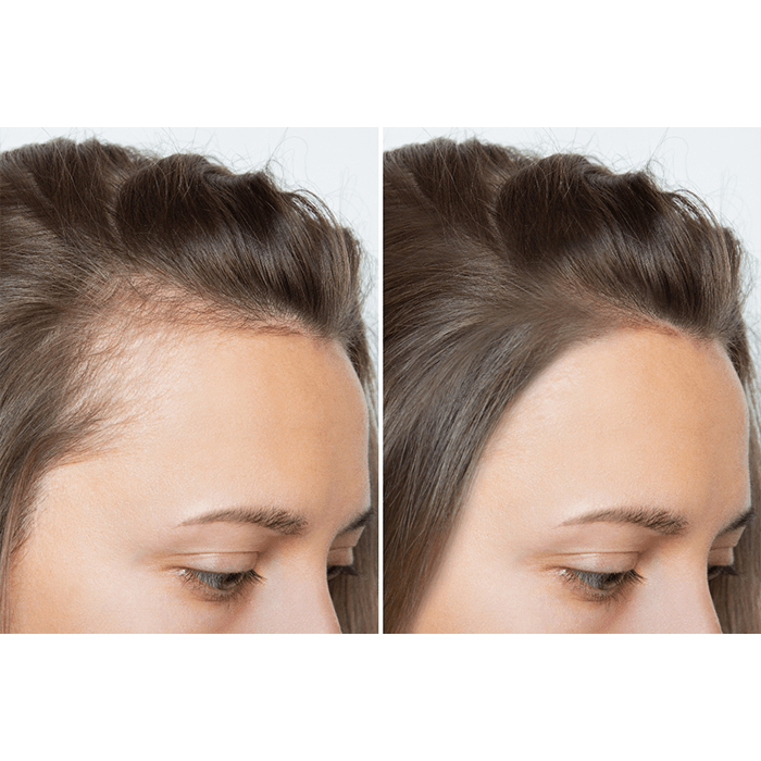Before and after PRP treatment