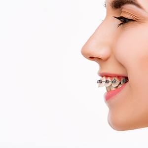 Nose-to-chin profile view of woman with overbite and braces