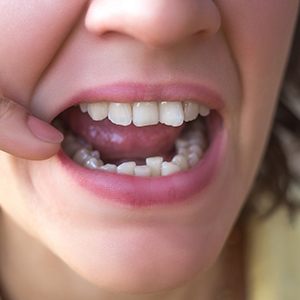 Nose-to-chin view of woman pointing to her lower arch of crooked teeth