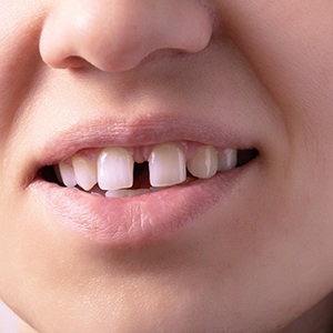 Nose-to-chin closeup of woman smiling with wider space between teeth
