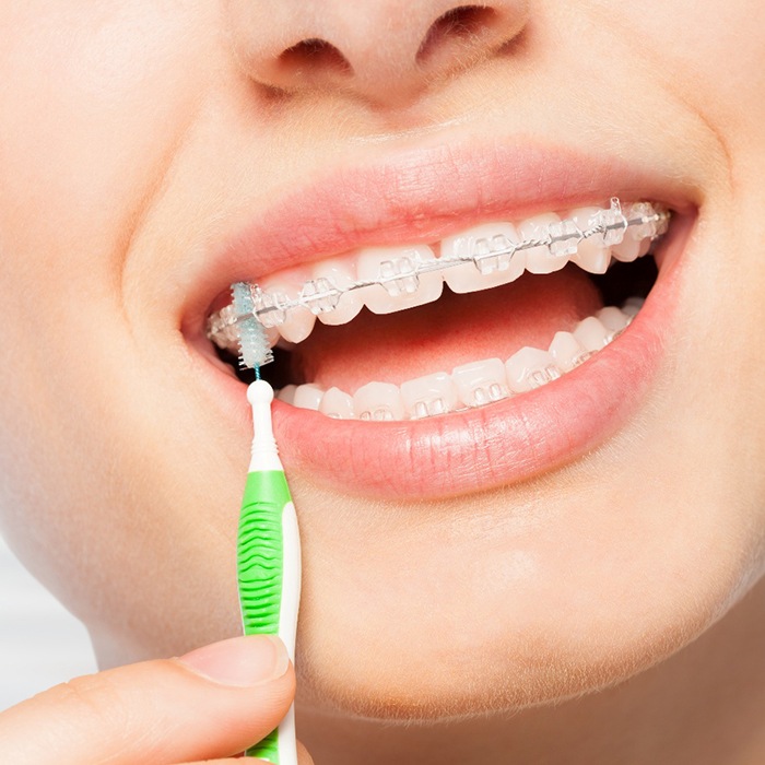 Nose-to-chin closeup of woman cleaning braces with interproximal brush